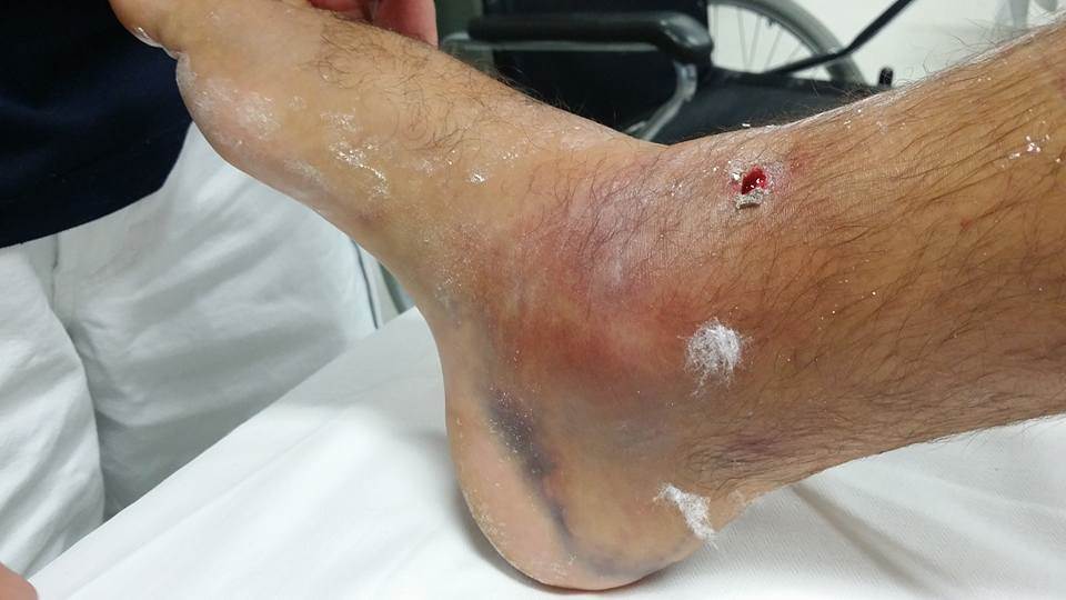 my ankle