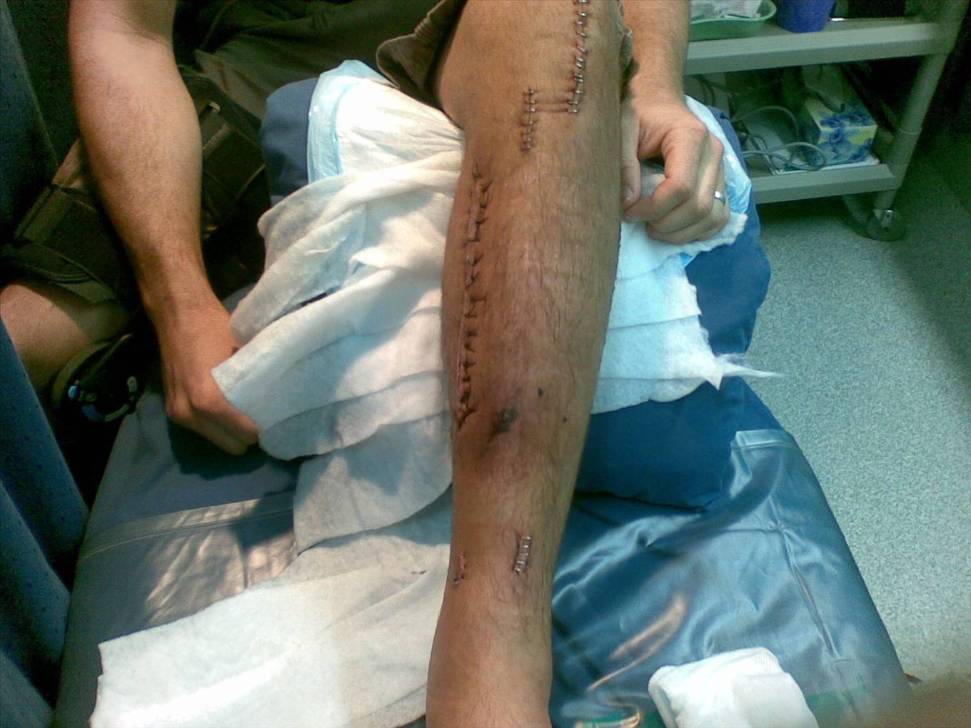 My broken leg after surgery... mmmm im hungry