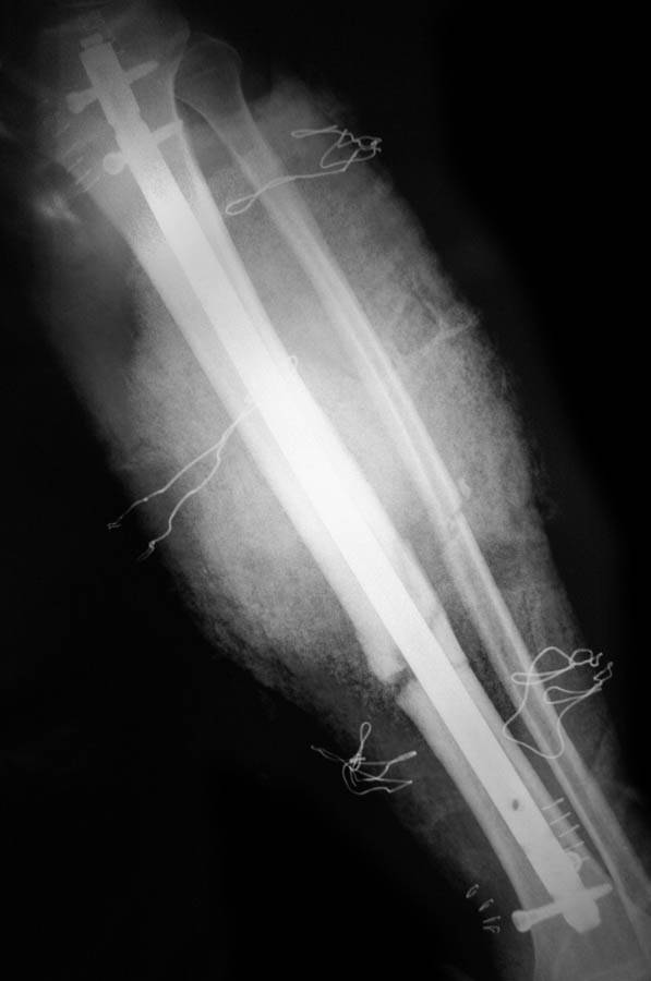 Broken Tibia and Fibula