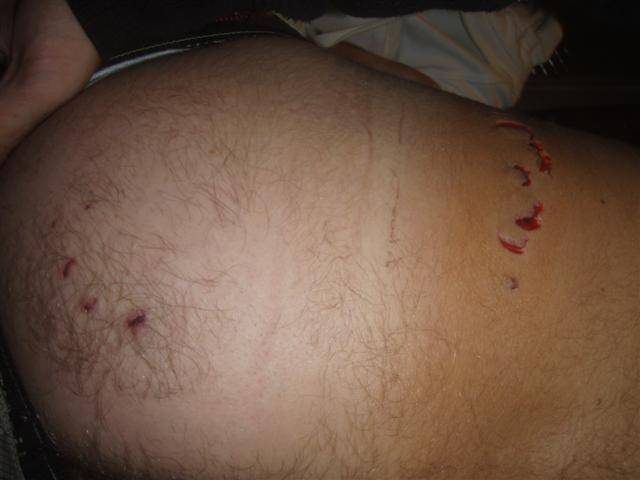 shark bite