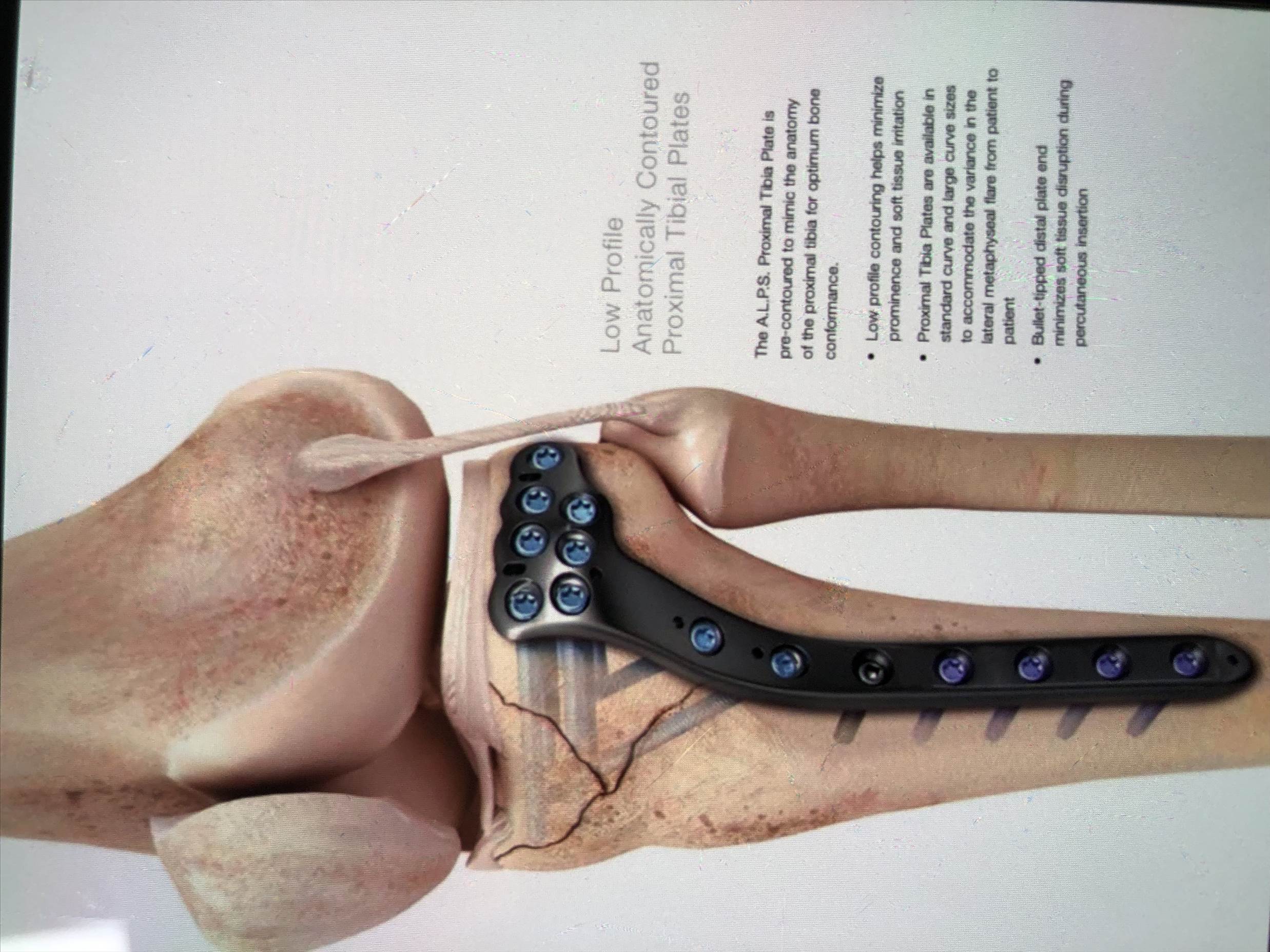 Injury