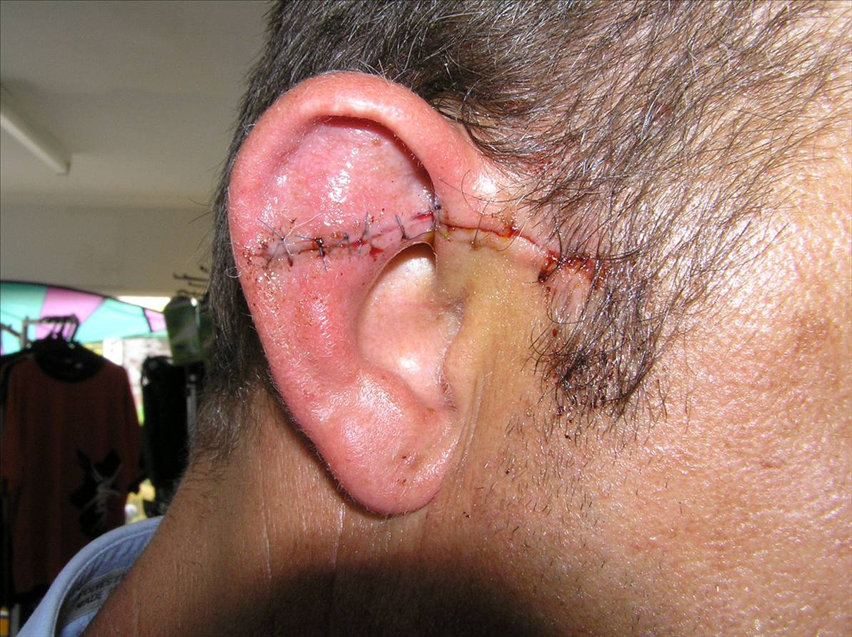 ear slice