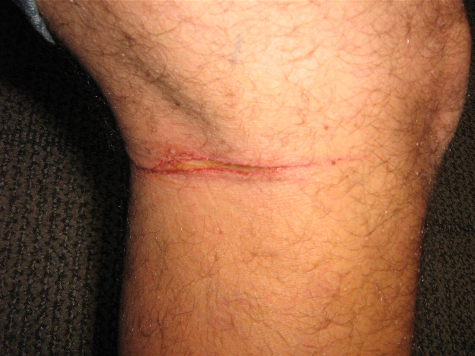 Legs vs lines!!  Not cool!!