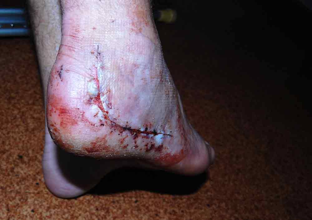 Heel Injury