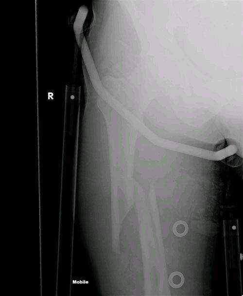 Fractured femure