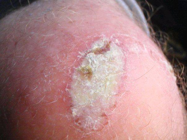 superglue