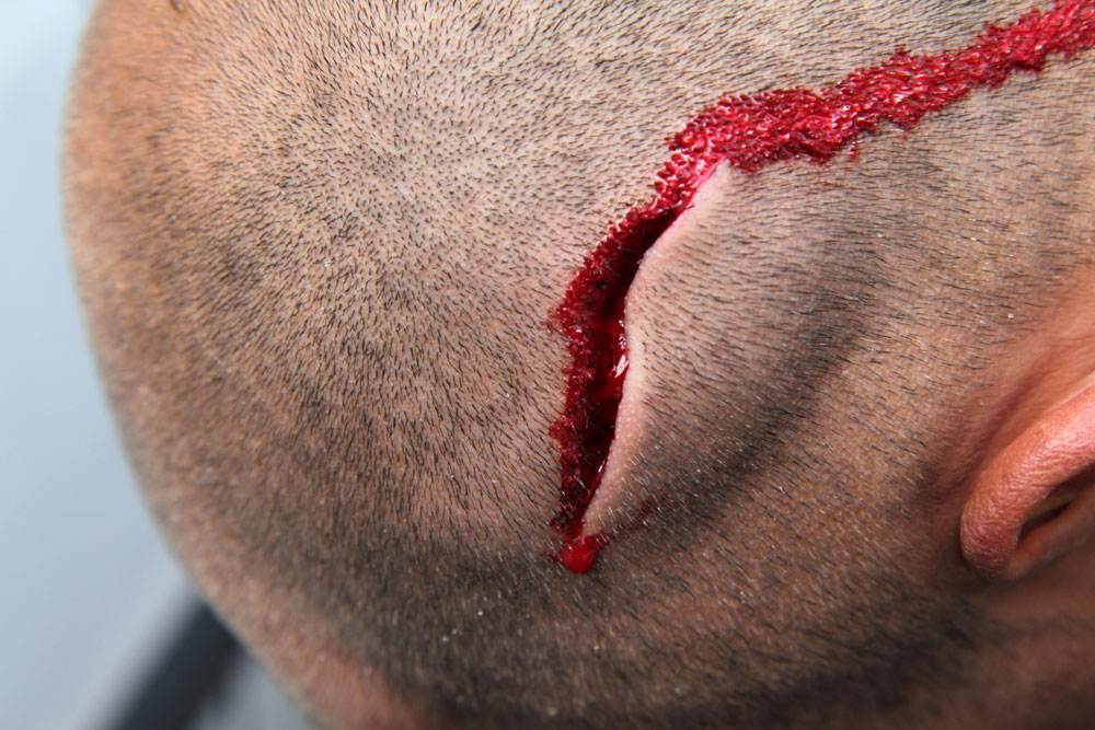 Board leash injury