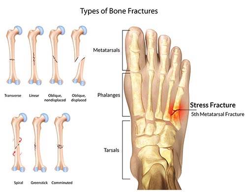 Foot-Fracture-Doctor-NYC