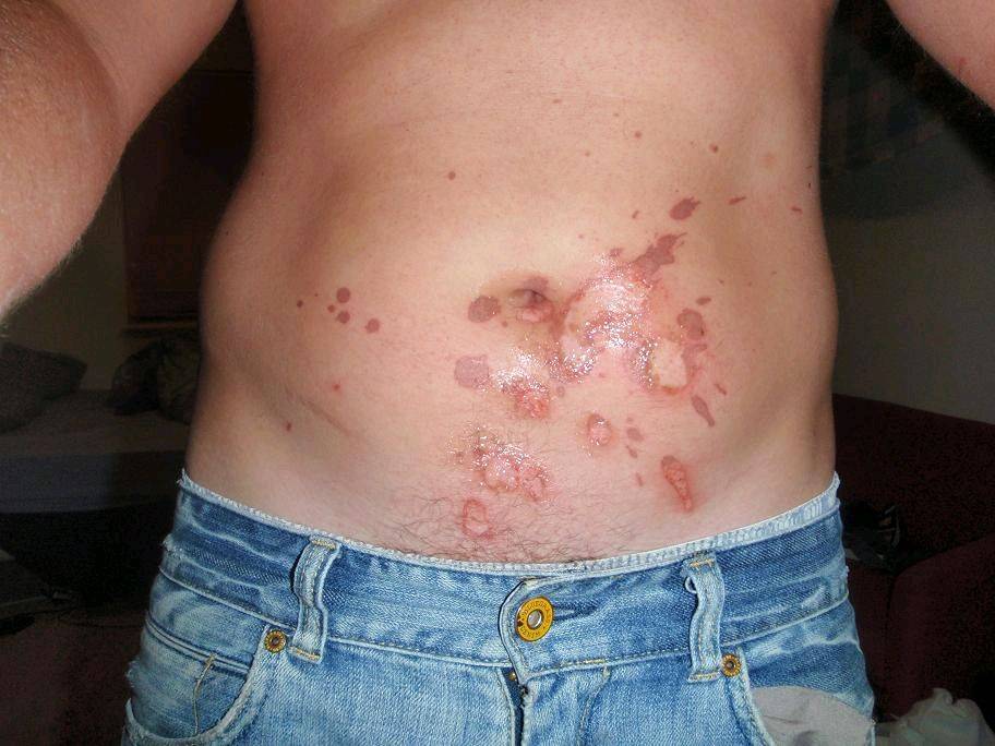 gut burn