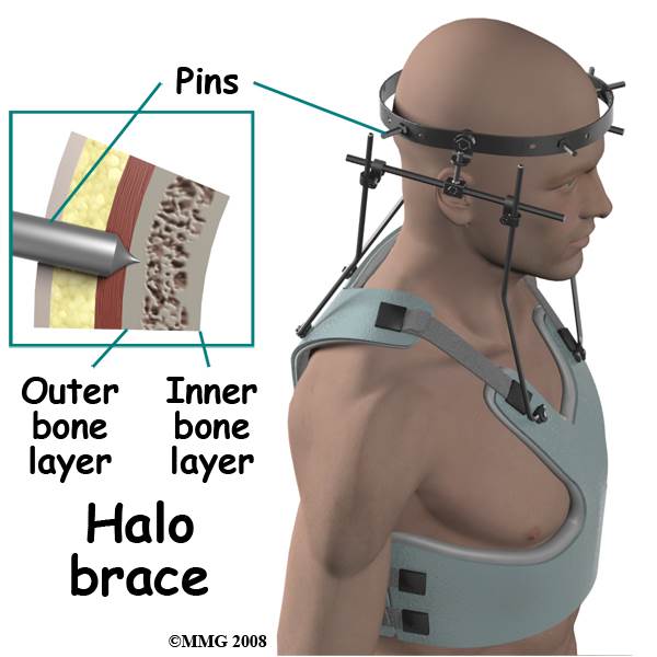neck fractures treatment