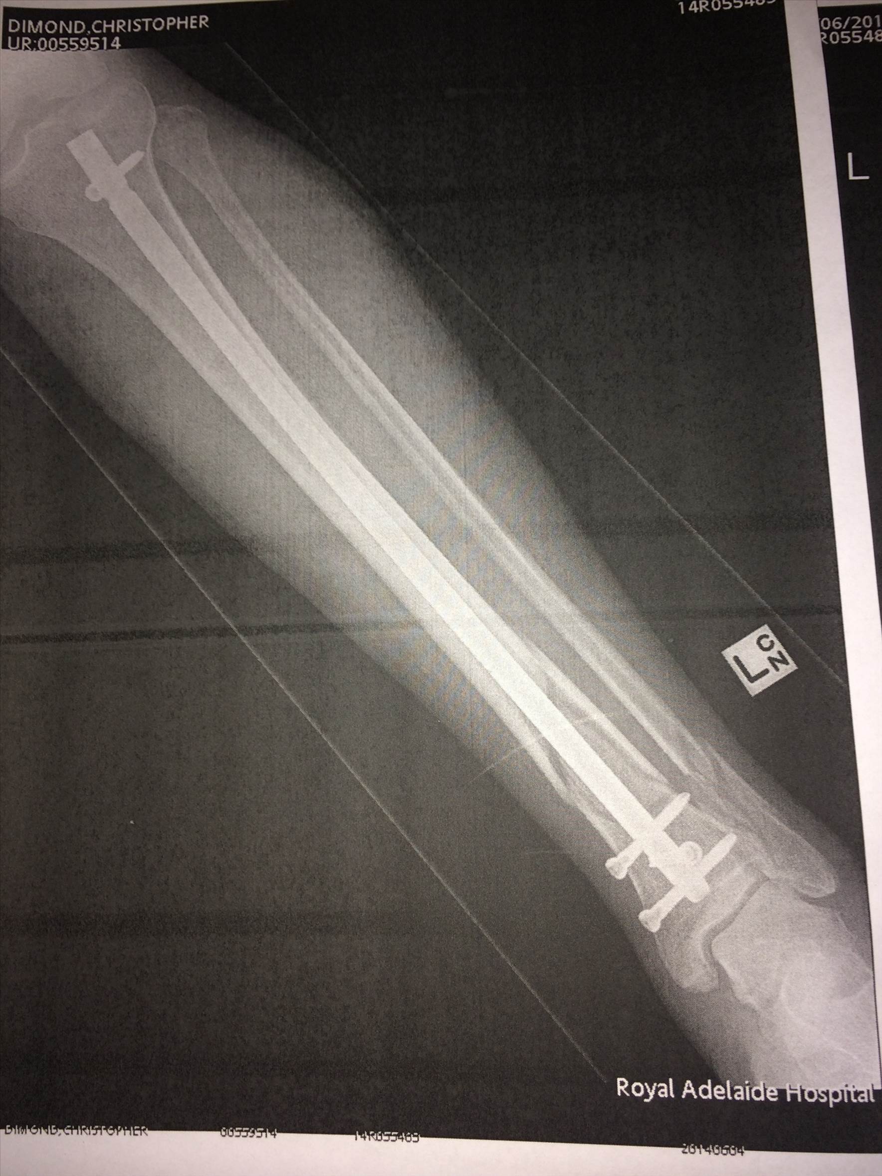 broken tib fib