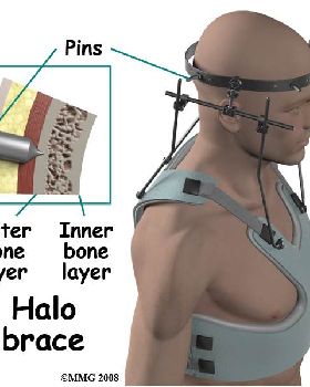 neck fractures treatment