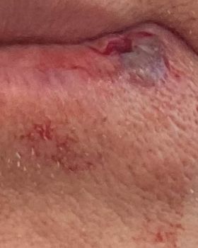 SPlit lip