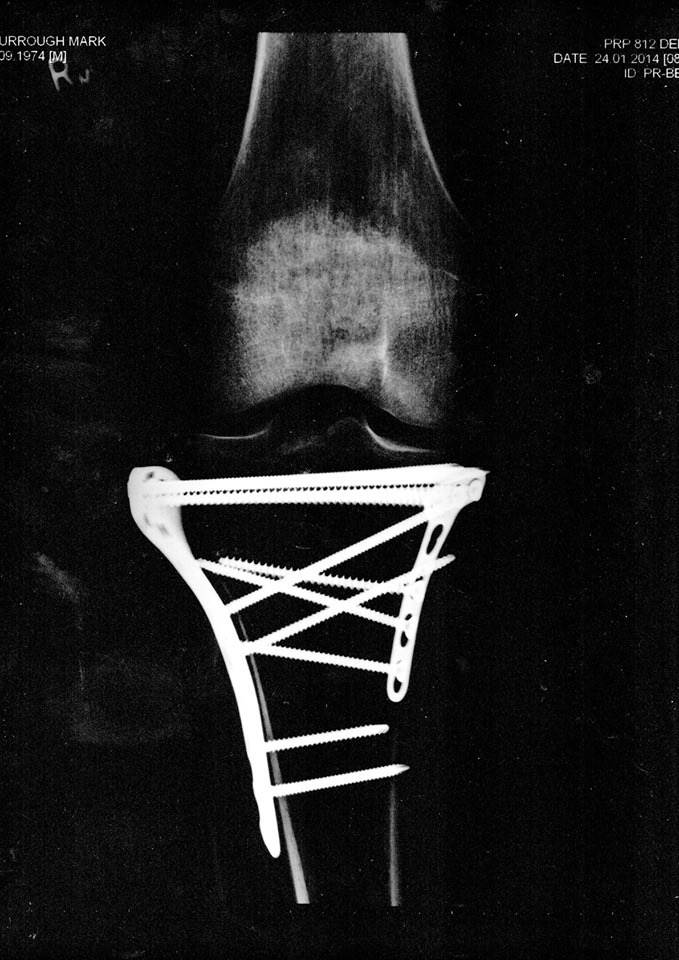 tibial plateau fracture