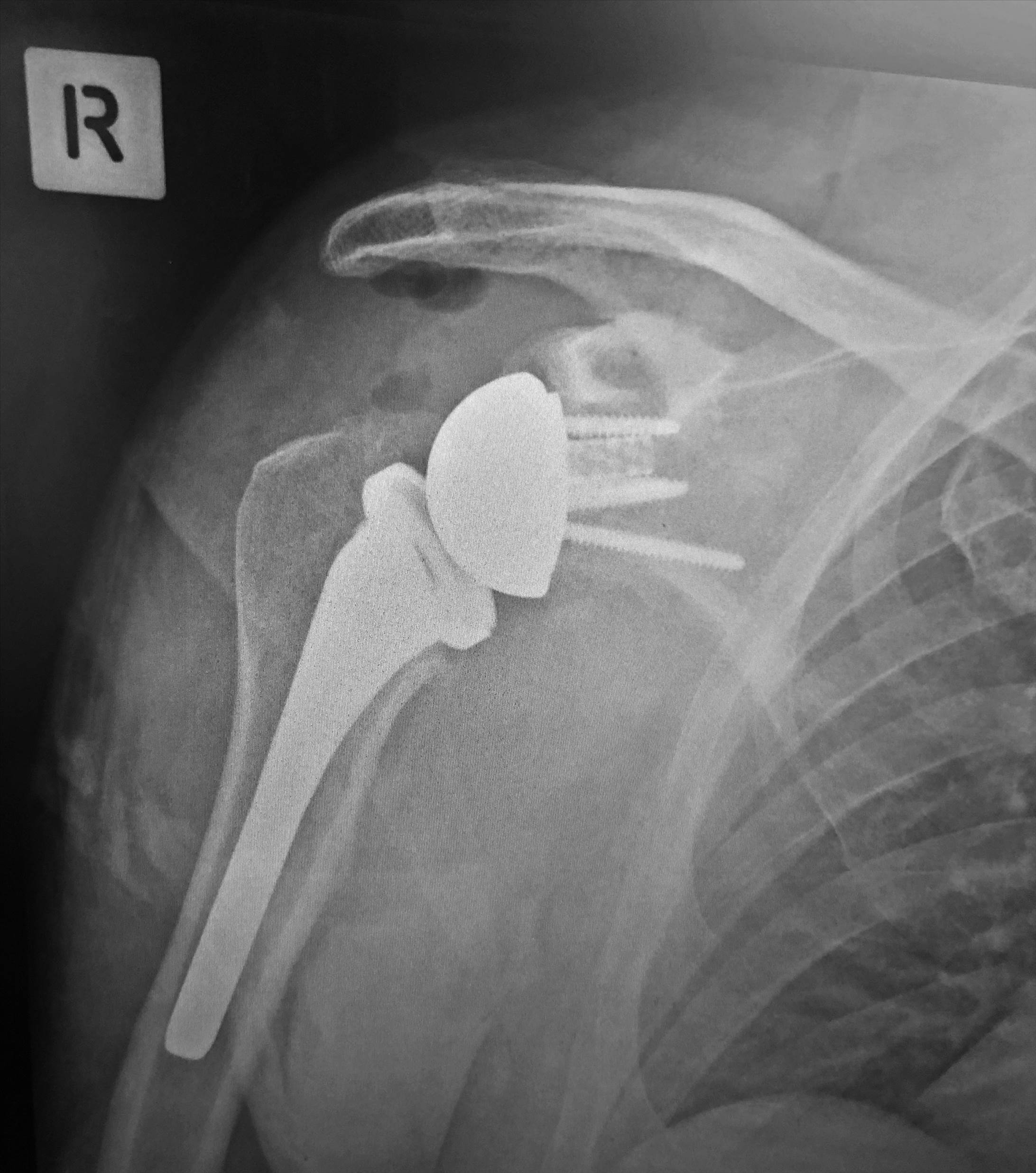 Shoulder replacement