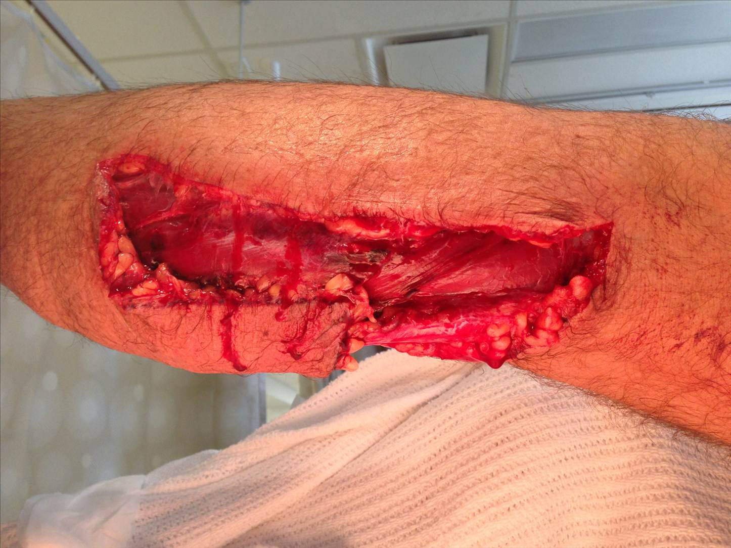 Leg gash