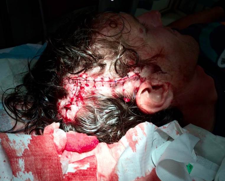 head stitches