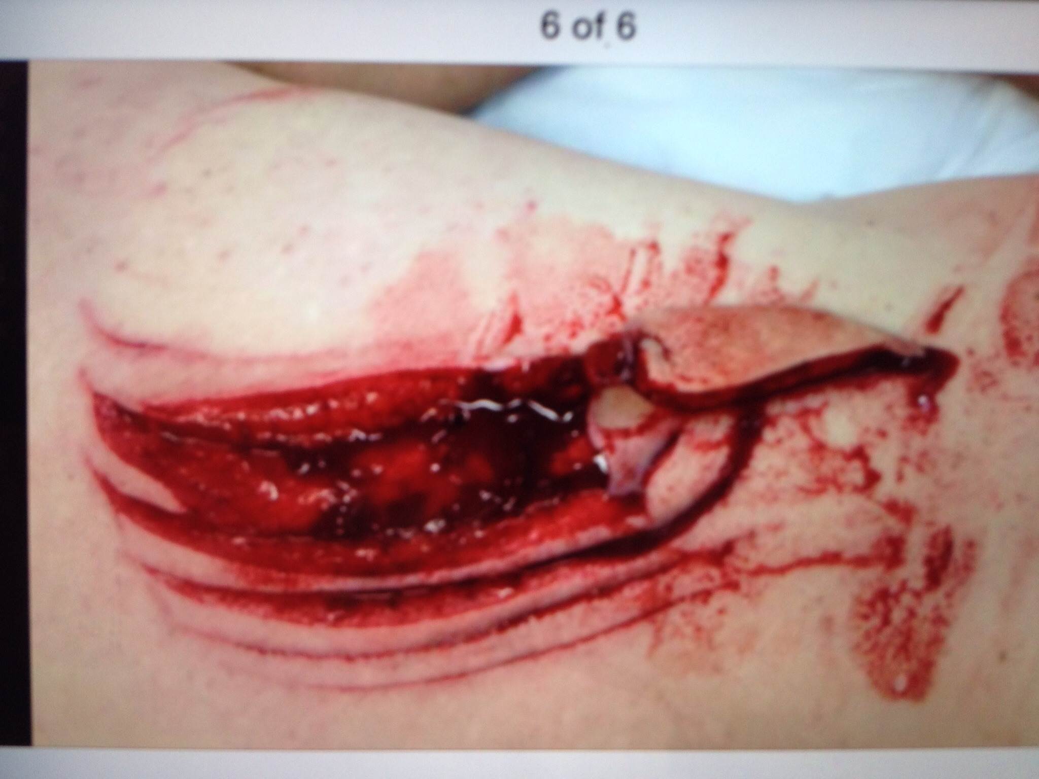 Shark bite