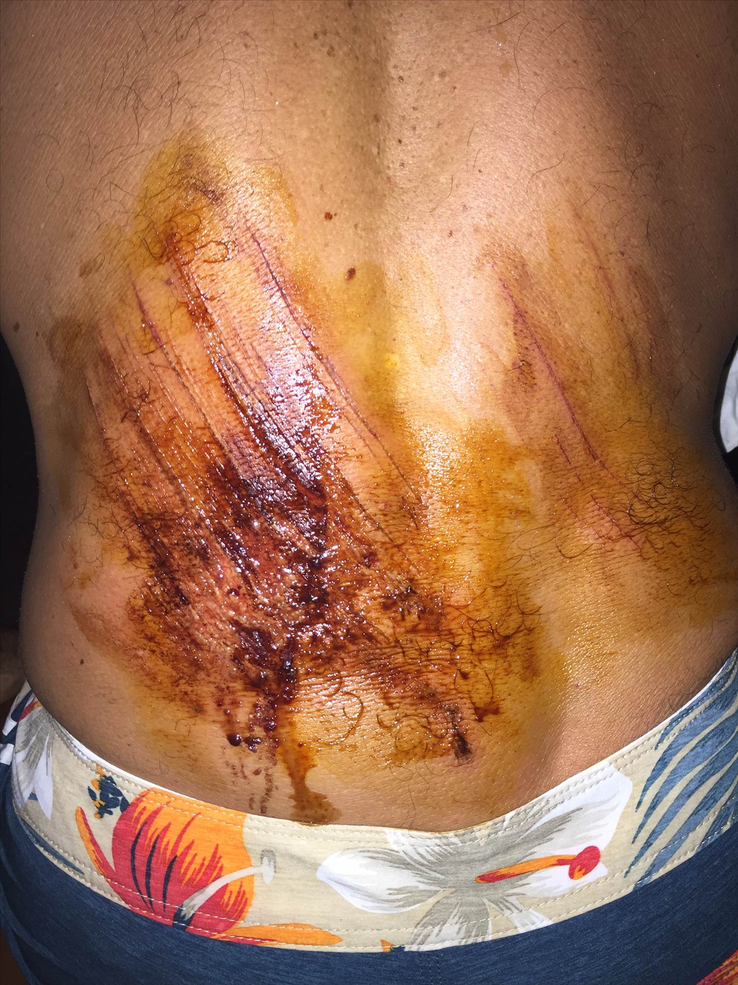 wound