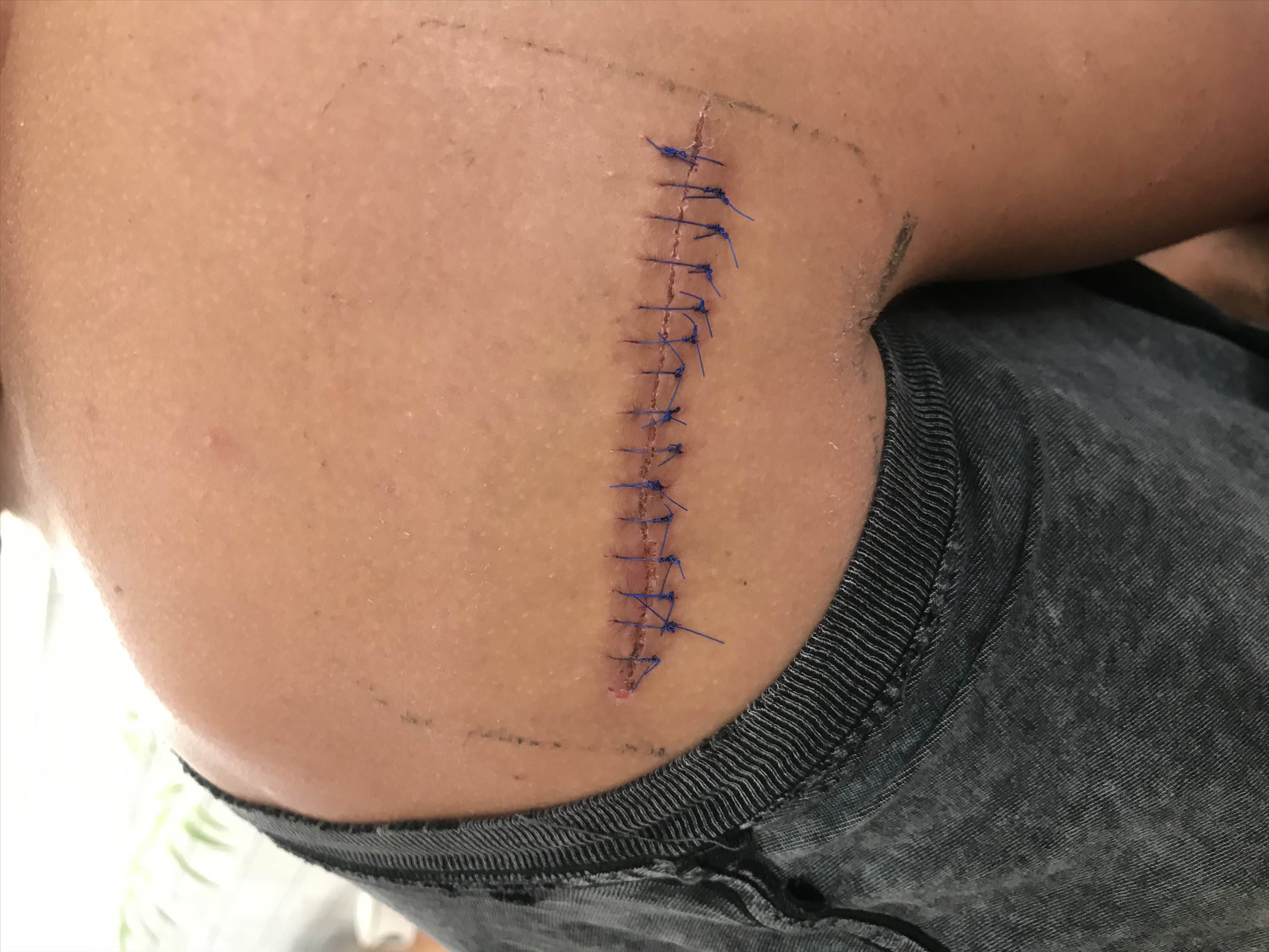 Medi stiched
