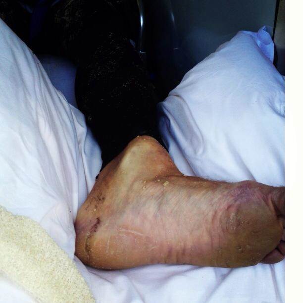 Daves Ankle