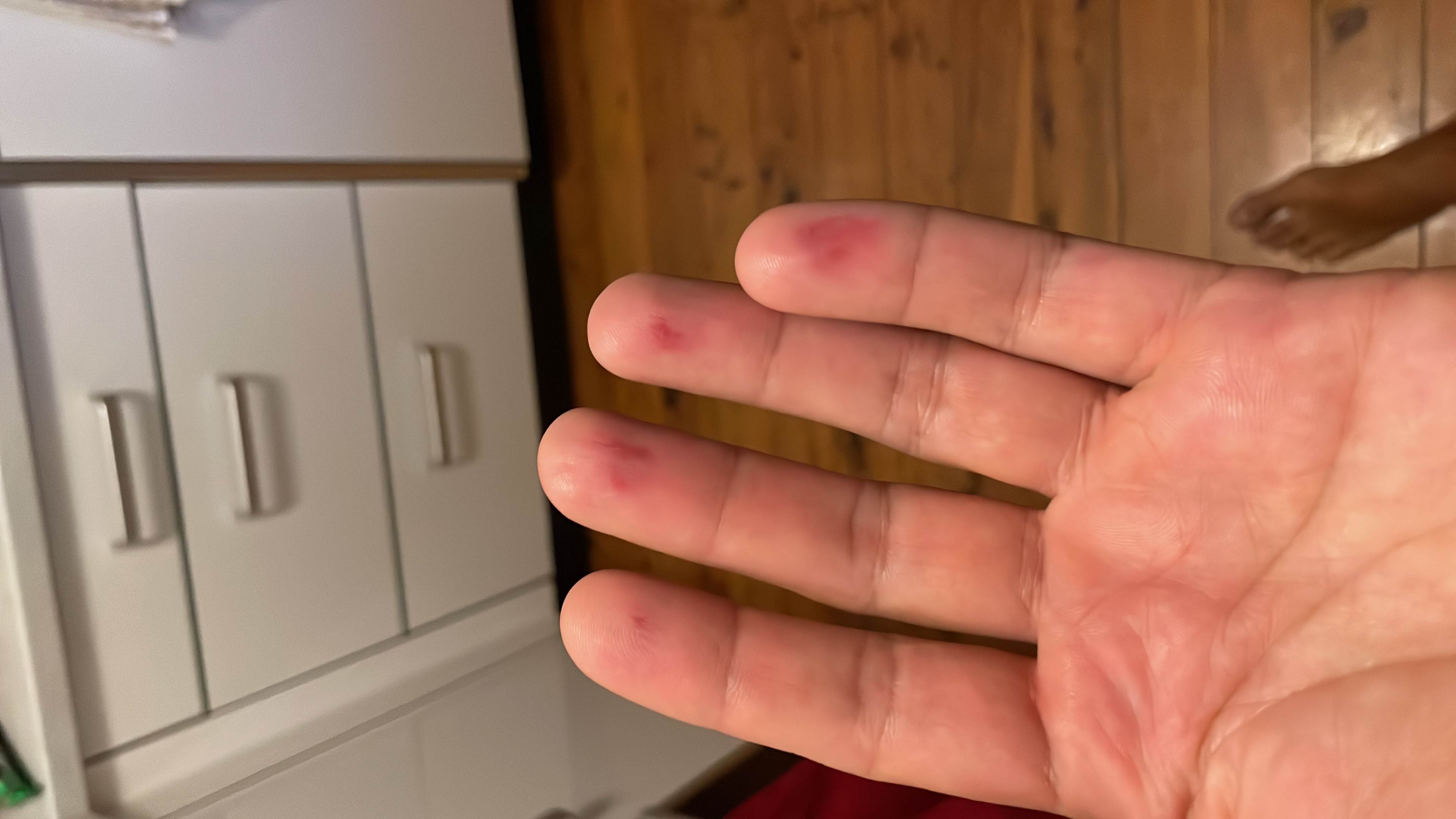 Bruised fingers