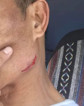 Laceration