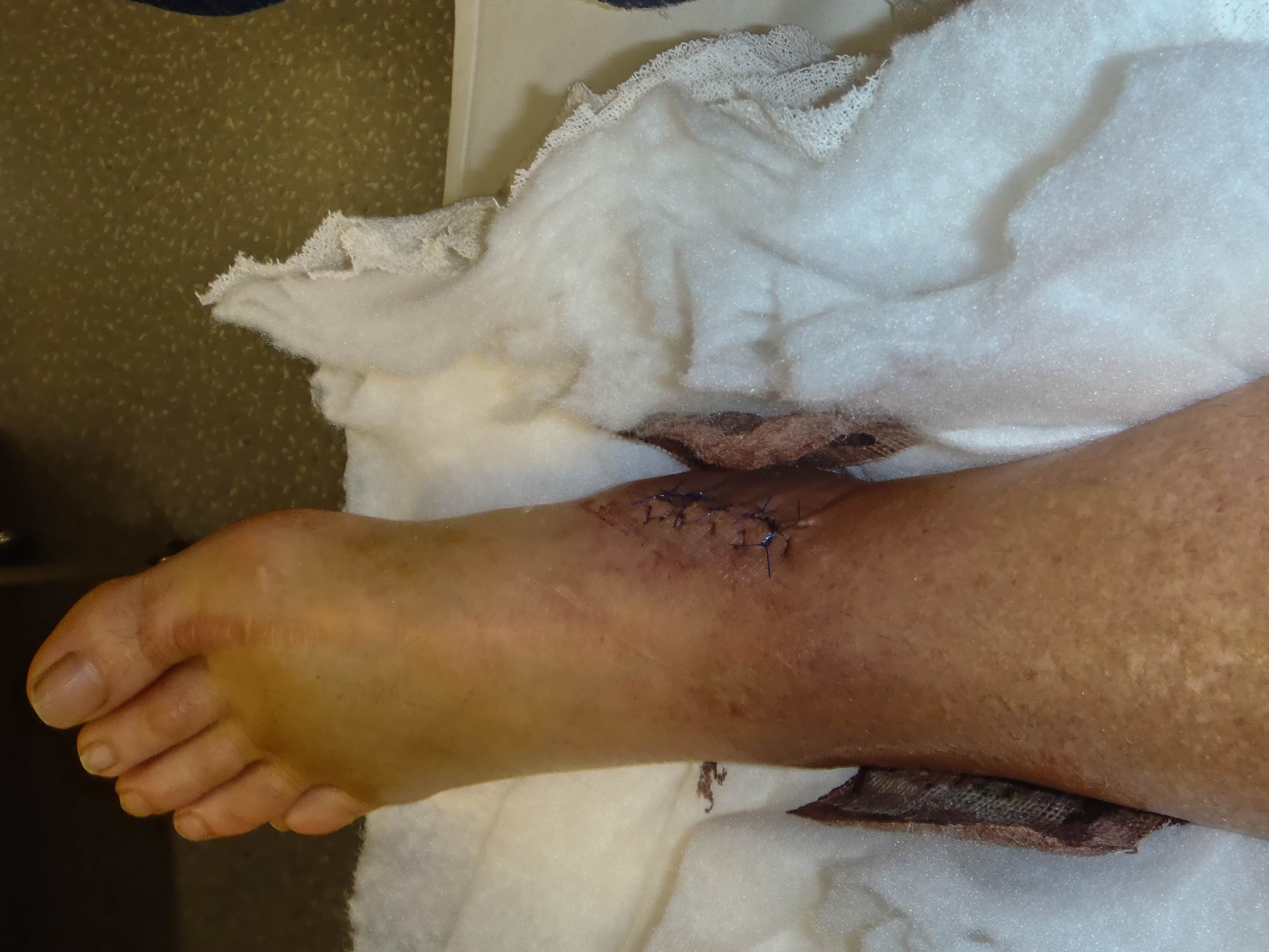 injury