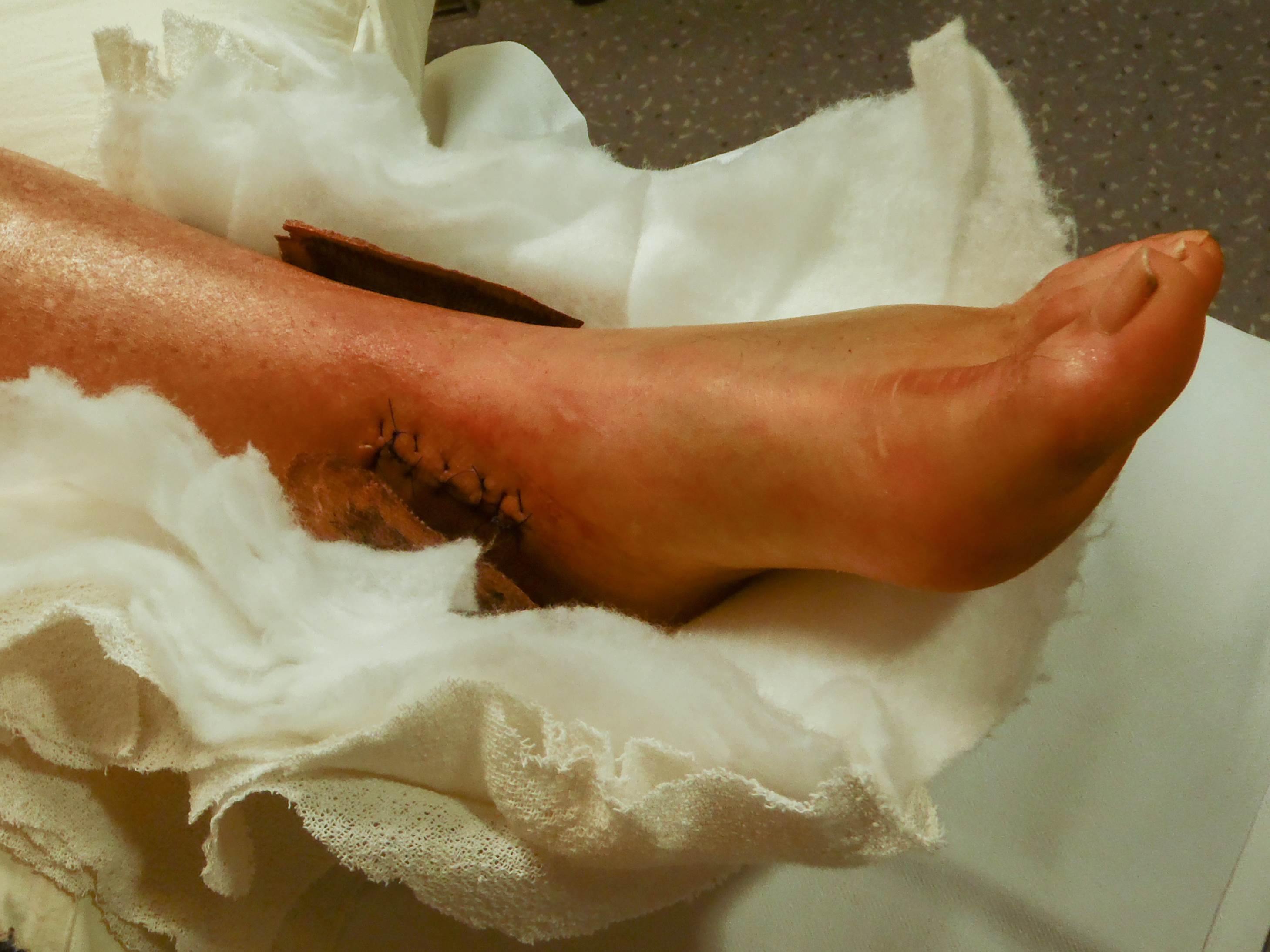 injury 1