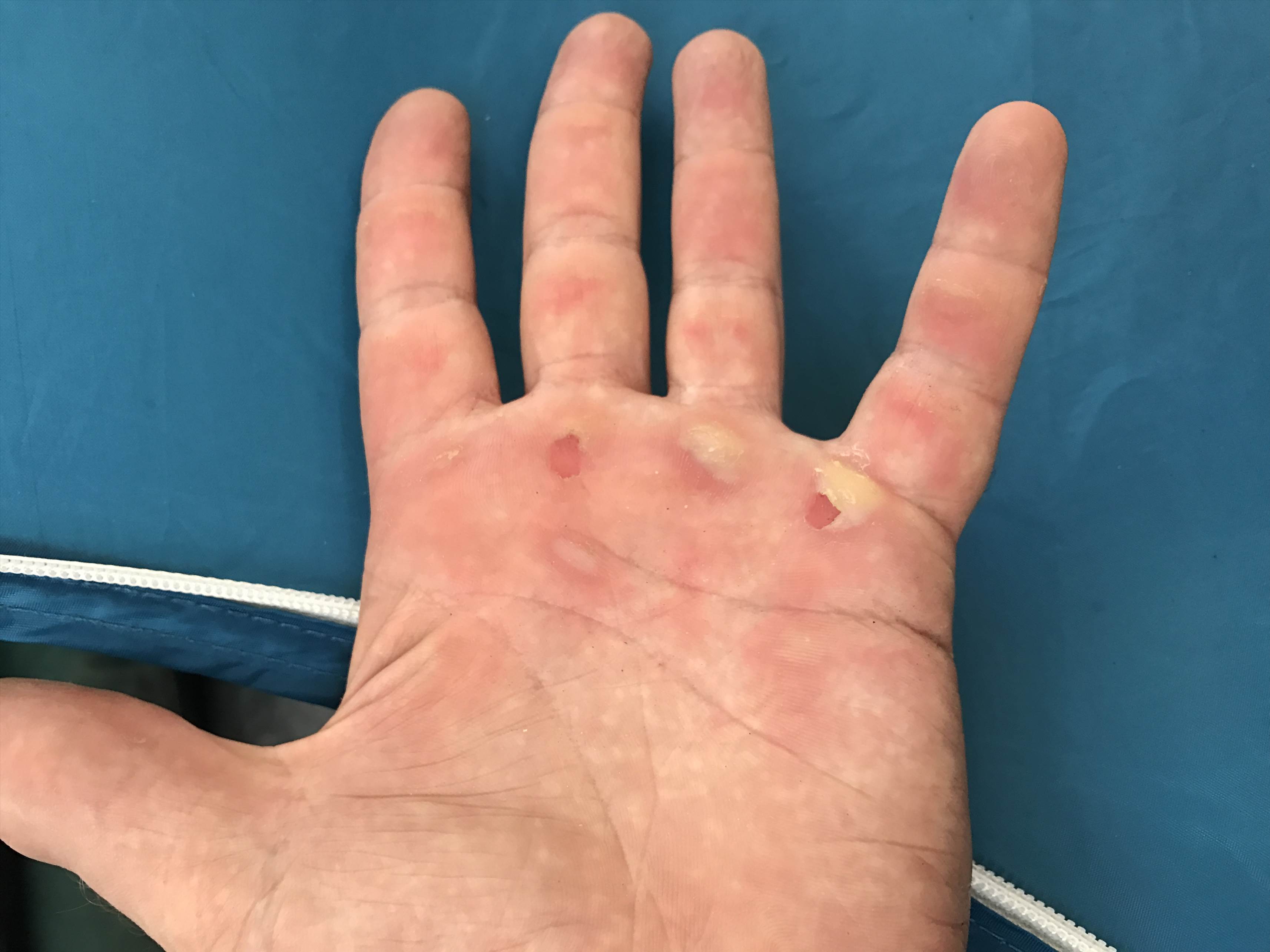 hand1