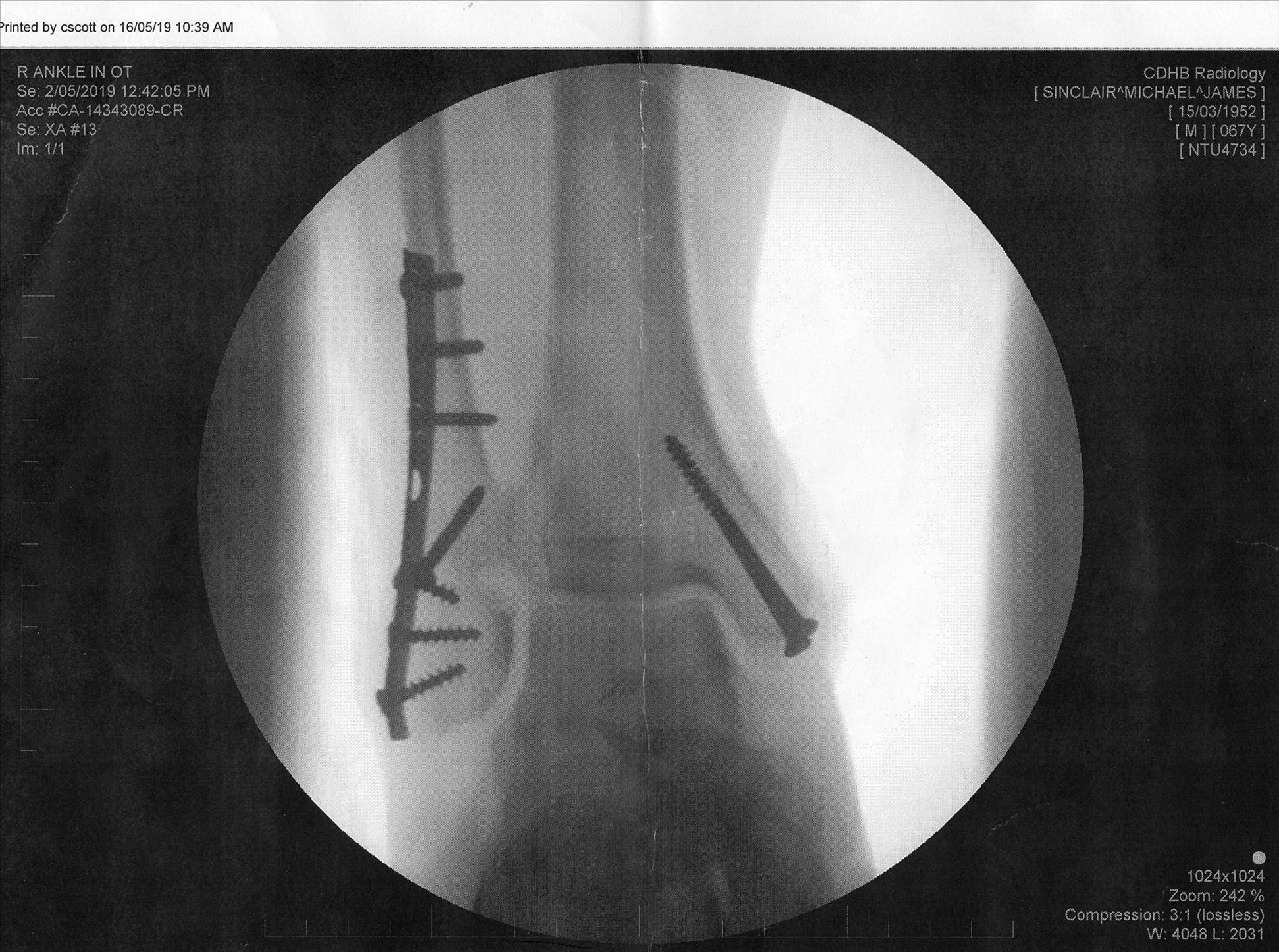 Ankle and screws001