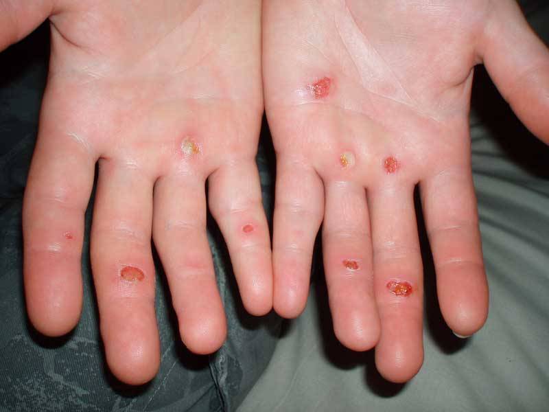 Nananu-i-Ra Blisters