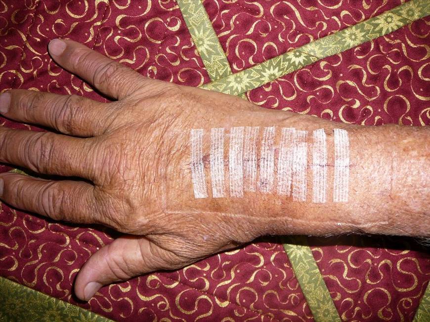 On the mend