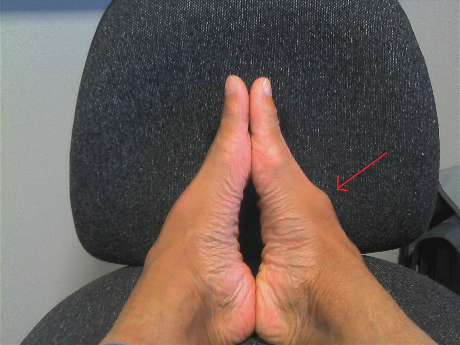 Foot injury
